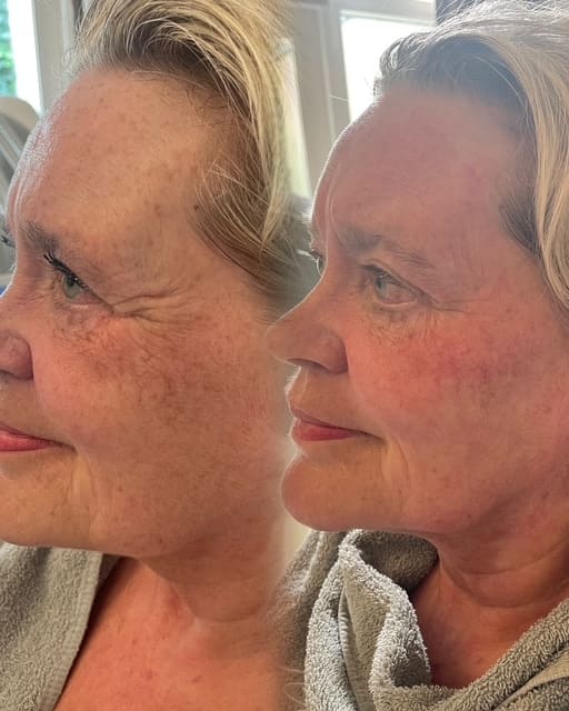Gezicht van dezelfde klant voor en na een kuur microneedling, van opzij gefotografeerd.