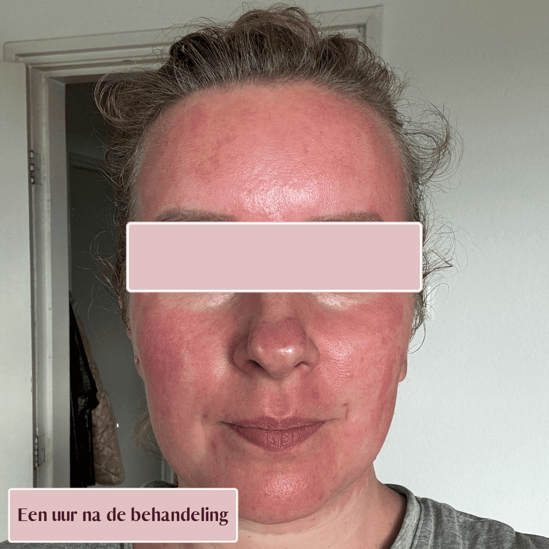 Gezicht met duidelijke roodheid, een uur na de microneedling-behandeling.