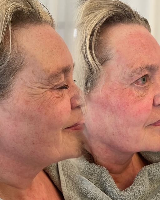 Gezicht van een klant voor en na een kuur microneedling, zijaanzicht.