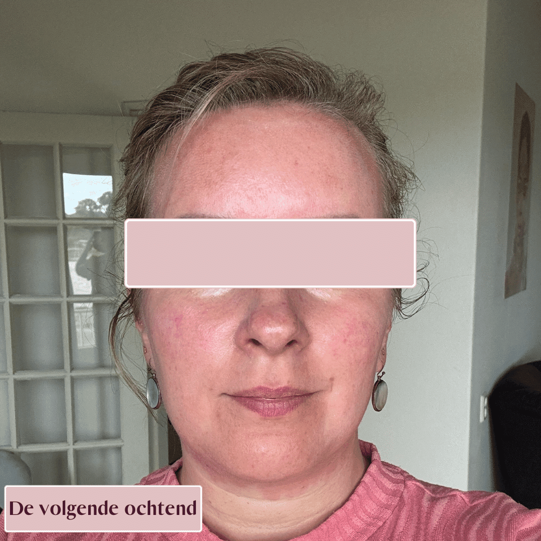 Hetzelfde gezicht de volgende ochtend, de roodheid is grotendeels verdwenen.